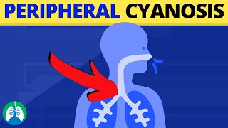 Peripheral Cyanosis Medical Definition  Quick Explainer Video [upl. by Tome]