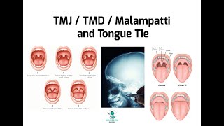 Mallampati and Tongue Tie [upl. by Vasyuta253]