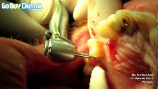 Straumann Compatible BioconceptDental Implant Surgery Step by Step V3 [upl. by Flosi]