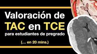 TCE en TAC en 20 minutos para médicos no especialistas [upl. by Anegue]