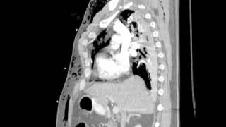 Blunt traumatic injuries of the lung parenchyma pleura thoracic wall and intrathoracic airways [upl. by Moriah]