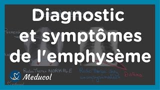 Emphysème symptôme distension thoracique Tiffeneau et dosage de alpha 1 antitrypsine [upl. by Ennaihs]