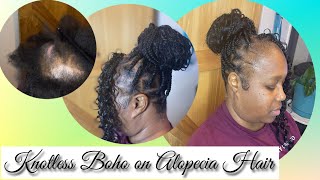 Yes you can get knotless Boho Braids with Alopecia [upl. by Grodin818]