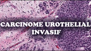 LE CARCINOME UROTHELIAL INVASIF – PATHOLOGIE [upl. by Anidal]