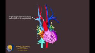 Transposition of Great Vessels – Mustard Procedure [upl. by Aoniak342]