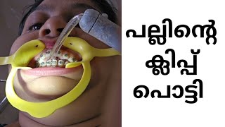 രണ്ടാഴ്ച്ച കൊണ്ട് ഞാൻ ക്ലിപ്പ് പൊട്ടിച്ചു  Braces pallinu kambiyittumalayalamvlog familyvlog [upl. by Weidner895]