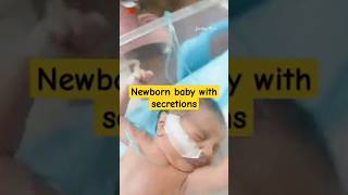 Ensuring Accurate NG Tube Position in Newborns [upl. by Tonkin]