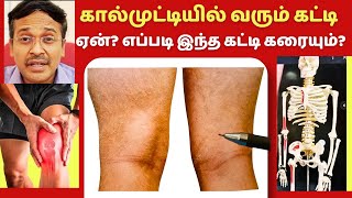 ஏன் கால்முட்டியில் இந்த கட்டி வருகிறது எப்படி கரைக்கலாம்  knee swelling pain bakers cyst [upl. by Rexferd263]