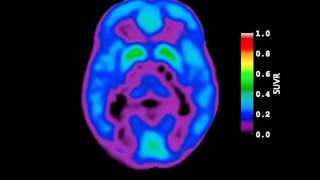 Video of AmyloidBeta Deposition in Autosomal Dominant Alzheimers Disease [upl. by Arymat938]