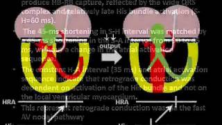 Parahisian Pacing 20111213wmv [upl. by Enneyehc142]