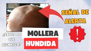 FONTANELAS HUNDIDAS  ALERTA 1 [upl. by Lefty]