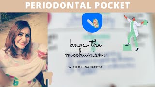 periodontal pocket carranza [upl. by Enohpets]