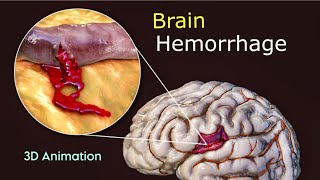 What Triggers Brain Hemorrhage  3D Animation  Scopic Vision [upl. by Onidranreb]