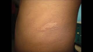 shagreen patch dermatology doctor neetpg fmge mbbs medical neet viral [upl. by Norahs4]