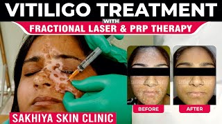 Vitiligo Treatment with Fractional Laser amp PRP Therapy  Sakhiya Skin Clinic [upl. by Asilak]