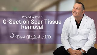 CSection Scar Tissue Removal  Procedure Part 5  David Ghozland MD [upl. by Favianus]