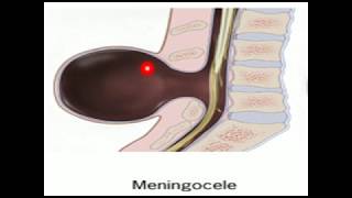 Meningocele y Mielomeningocele [upl. by Jacquie]