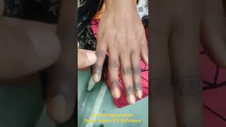 हाथों का कालापन Knuckle pigmentation in vitamin B12 folate deficiency Addison hemochromatosis etc [upl. by Koziel5]