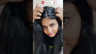 Dandruff treatment at Home  home remedy for dandruff  dandruff home remedy [upl. by Bevash]