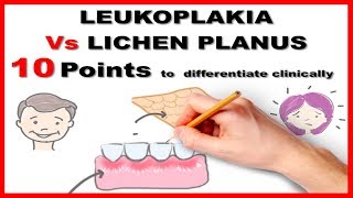 leukoplakia vs lichen planus  10 points to differentiate clinically [upl. by Atneuqal]