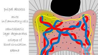 Acute Pulpitis  Diseases of Pulp Part 3 [upl. by Galatea]