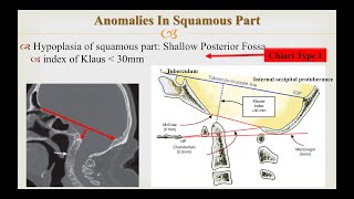 Craniovertebral Junction Anomalies Part 1 Occipital Anomalies Chiari Malformations [upl. by Aenad]