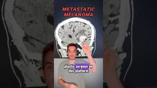 A sad case of metastatic melanoma [upl. by Aihsatsan645]