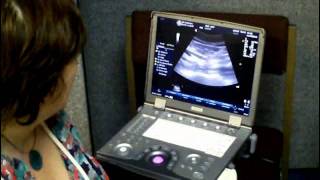 Abdominal Aortic Aneurysm screening demonstration [upl. by Allisan748]