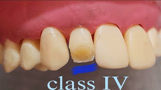 حشو الكمبوزيت خطوه ب خطوه Composite restoration class IV step by step [upl. by Melvena]