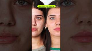 How to Treat Hormonal Acne Before amp After  eyeam 👁️ ❇️ wellness [upl. by Yoc413]