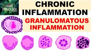 INFLAMMATION Part 9 Chronic Inflammation  GRANULOMATOUS INFLAMMATION [upl. by Bridwell]