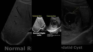 Liver Hydatid Cyst On Ultrasound  Normal Vs Abnormal USG  Abdominal Sonography shorts [upl. by Wilone]