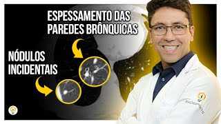 ACHADOS PULMONARES na Tomografia de Tórax Paciente de 60 anos [upl. by Fiske]