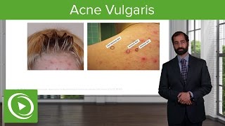 Inflammatory Skin Diseases Acne Vulgaris – Pathology  Lecturio [upl. by Seyah]