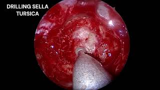 Endoscopic Transsphenoidal Hypophysectomy for Pituitary MacroadenomaDr Babu ARJSS AHER Mysore [upl. by Balsam68]