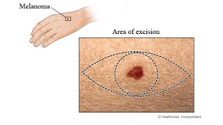 EXCISION OF LESION diameter  margins [upl. by Arata]