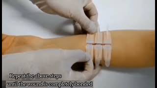 Wound closing device demonstration [upl. by Blanka]