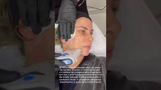 Aplicação UltramedUltraformer facial  Ultrassom microfocado [upl. by Yerffej]