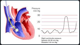 Insertion of a Pulmonary Artery SwanGanz Catheter [upl. by Nosliw]