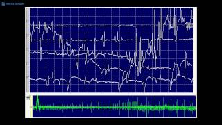 Kimura amp Kohara F22 Myotonic and spontaneous single muscle fiber discharges [upl. by Jacie]