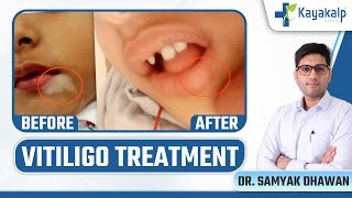 Segmental Lip Vitiligo की Amazing Recovery  Segmental Vitiligo Treatment  Kayakalp Global [upl. by Anitnahs403]