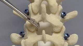 Posterior Lumbar Interbody Fusion PLIF spine surgery [upl. by Aslehc901]