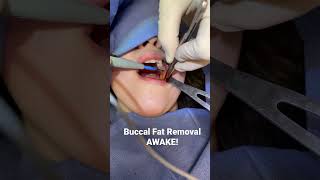 Buccal fat pad removal real surgical footage AWAKE in office Dr Kirk Lozada [upl. by Gautious]