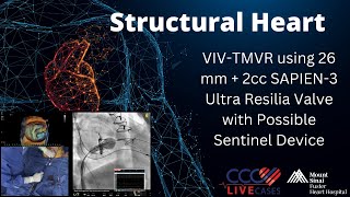 VIVTMVR using 26 mm  2cc SAPIEN3 Ultra Resilia Valve with Possible Sentinel Device [upl. by Enyleuqcaj]