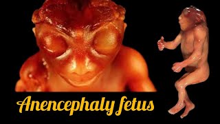 Anencephaly Fetus  histomuseum [upl. by Atinus725]