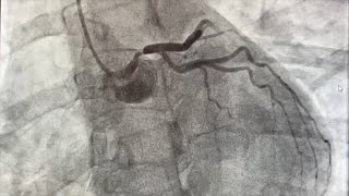 Angiography of the Left Main Coronary Artery [upl. by Nonnelg]