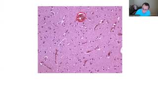 NEUROPATHOLOGY BOARD REVIEW 1 [upl. by Verile781]