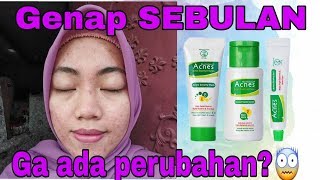 SEBULAN PAKAI ACNES INI KONDISI MUKA AKU [upl. by Etnuaed]