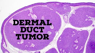 Dermal duct tumor vs poroma vs hidradenoma acrospiroma quotfamilyquot of sweat gland tumors dermpath [upl. by Innos578]