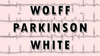 WolffParkinsonWhite Syndrome [upl. by Niamjneb683]